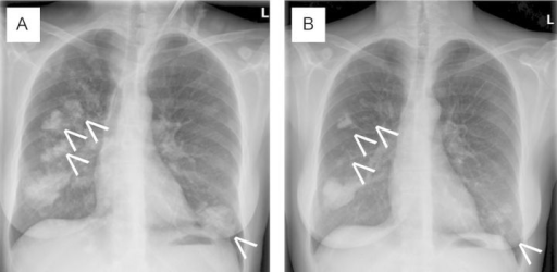 Chest X-rays. Diffuse nodular opacities can be seen in | Open-i