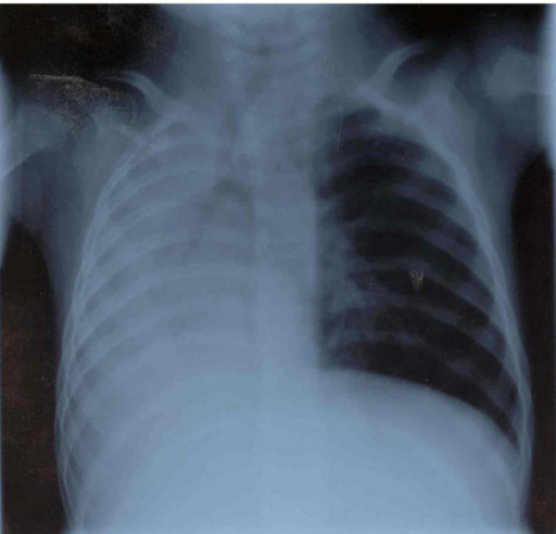 Chest X-ray shows persisting total atelectasis of the r | Open-i