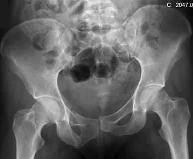 Initial pelvic injuries seen on an anteroposterior pelv | Open-i