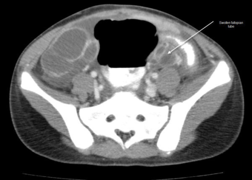 CT scan of the abdomen and pelvis with intravenous and | Open-i