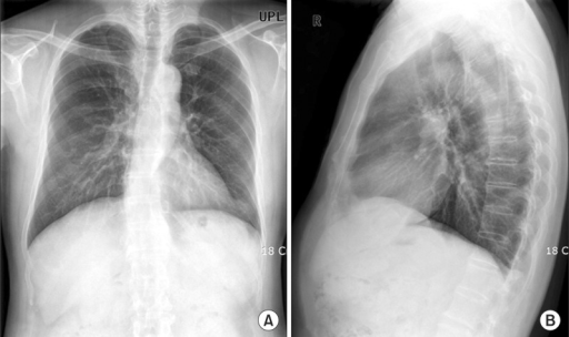 Anteroposterior (A) and lateral (B) x-rays in thoracic | Open-i