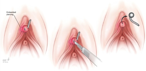 Glans of the clitoris photo 124