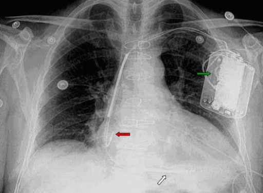 icd-10-dx-code-for-chest-x-ray