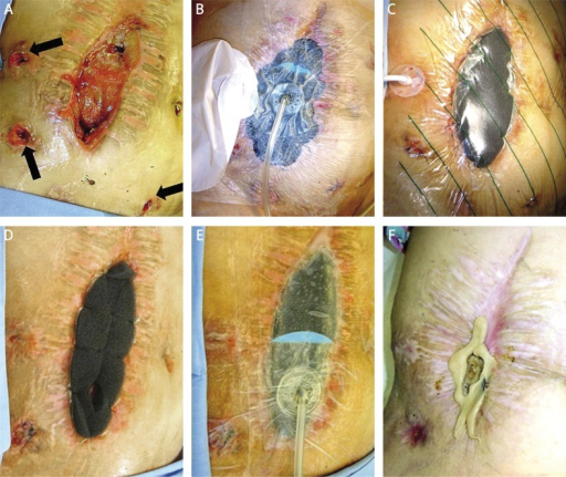 Patient 1. A – wound before VAC treatment, 2 fistulas | Open-i