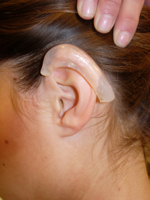 Patients' left ear after keloid excision with silicon p | Open-i