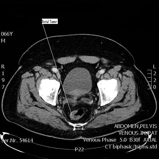 CT scan showing the thickenned wall of the rectum sugge | Open-i