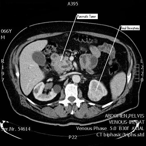 ct-scan-of-the-abdomen-showing-the-pancreatic-tumor-and-open-i