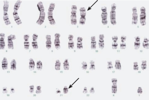 Cytogenetic Analysis Of The Bone Marrow Disclosed 46,XY | Open-i