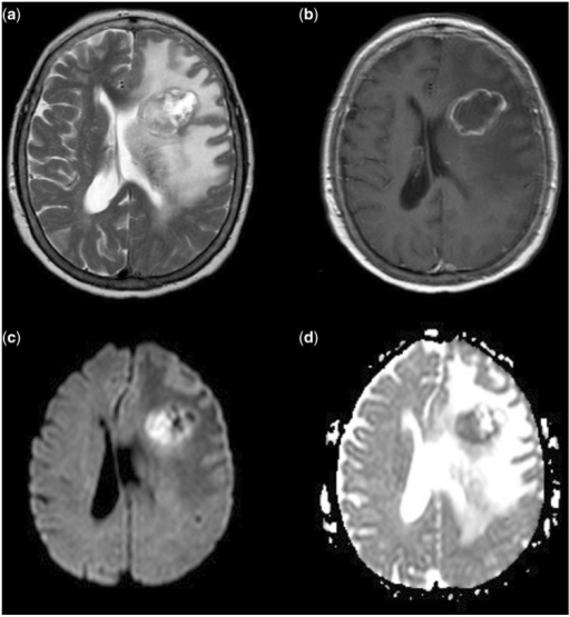 Restricted diffusion in cerebral metastases. (a) T2-wei | Open-i