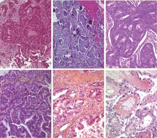 Histopathology of ovarian epithelial tumors.A, high-gra | Open-i