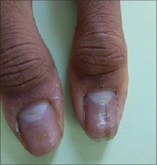 Median Canaliform Dystrophy