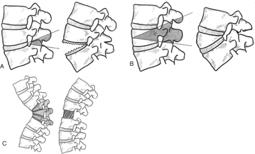 Schematic diagram of the three osteotomies, showing the | Open-i