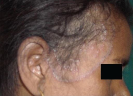 tinea capitis scalp adult