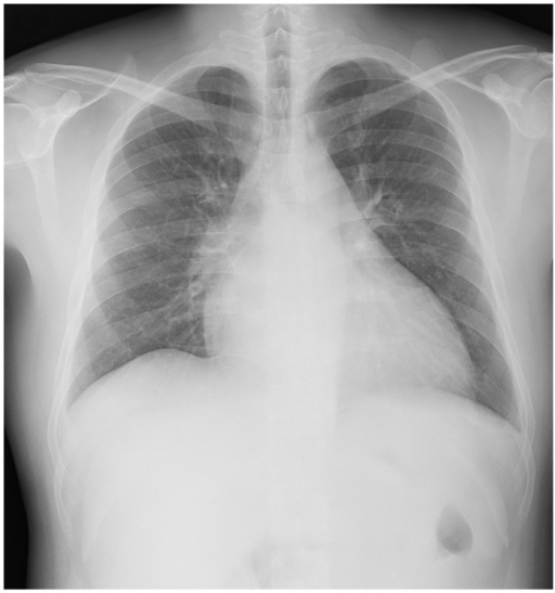 Chest X-ray Shows Cardiomegaly And No Pulmonary Edema. 