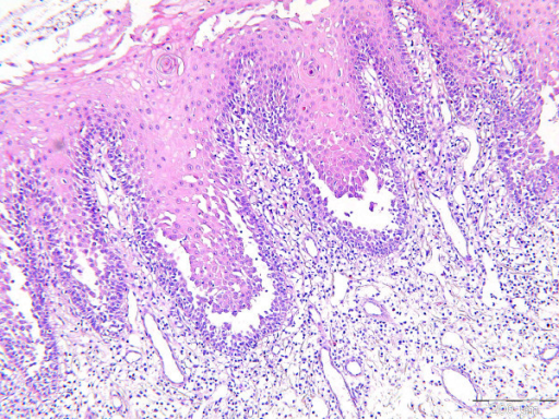 Histology of oral mucosa of pemphigus vulgaris shows ac | Open-i