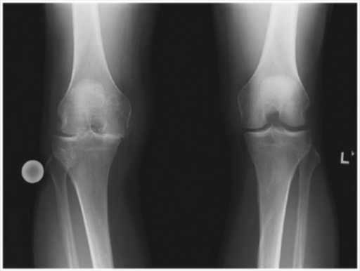 Rosenberg View Radiograph Of Knees Note The Right Knee Open I