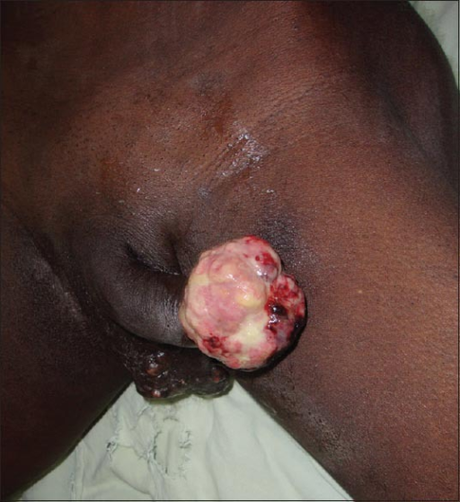 Sebaceous Cysts Penis 45