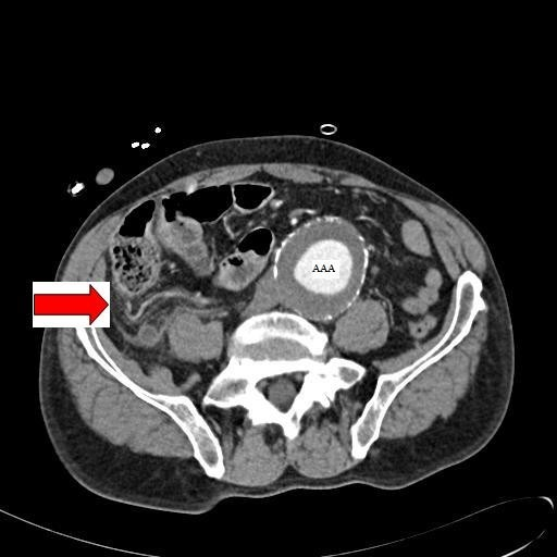 Abdominal CT image with contrast taken on the day of ad | Open-i