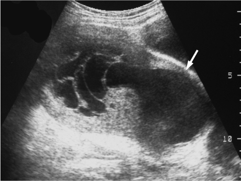 Endometrial stromal sarcoma that presented as a huge ce | Open-i