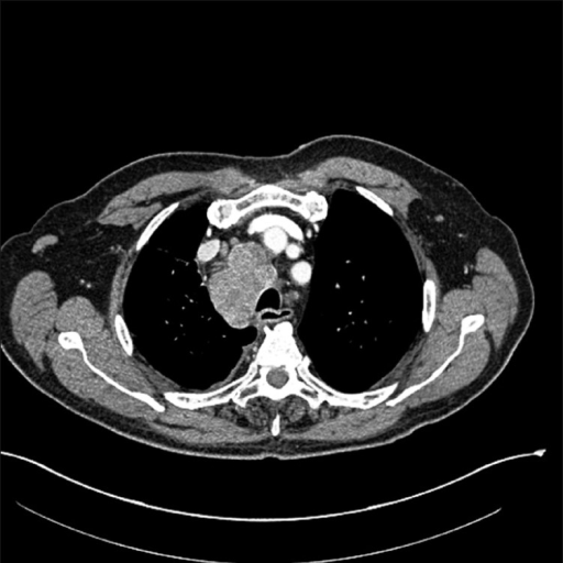 CT image of chest showing right hilar mass and enlarged | Open-i