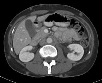 CT scan of subcutaneous metastatic nodule. | Open-i