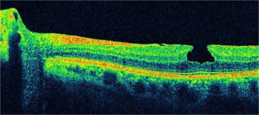 Spectral Domain Optical Coherence Tomography Images Of A 63 Year Old MaleNotes Spectral Domain Optical Coherence Tomography Images Of A 63 Year Old MaleNotes