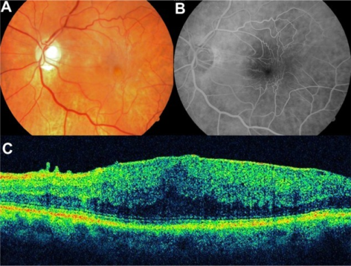 Notes A Color Photograph Of An Epiretinal Membrane Vascular Notes A Color Photograph Of An Epiretinal Membrane Vascular