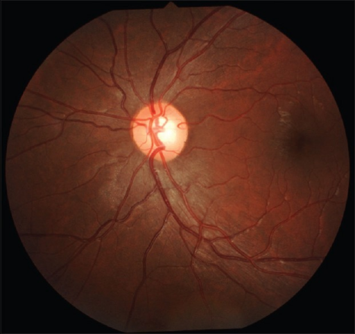 Fundus photograph OS - showing dull foveal reflex after | Open-i