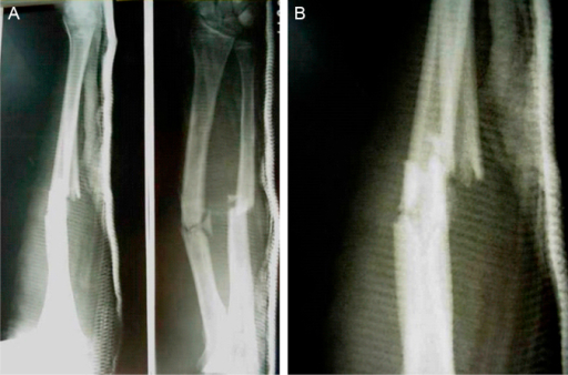 X ray after closed reduction of forearm fracture. Open i