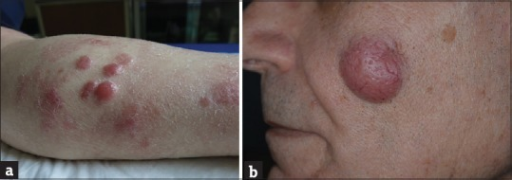 Typical Aspect Of Primary Cutaneous Diffuse Large B Cel Open I 