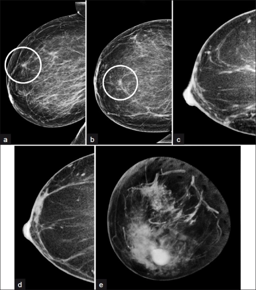 A Fifty Two Year Old Woman With Developing Focal Asymme Open I   PMC3307212 JCIS 2 7 G006 