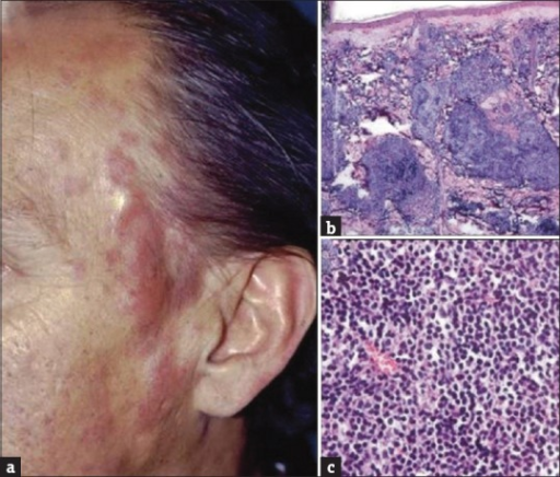 Primary Cutaneous Follicle-center Lymphoma. (a) Multino | Open-i