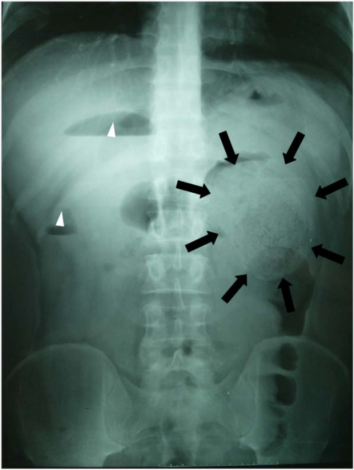 abdominal-plain-film-black-arrow-showed-a-large-mass-open-i