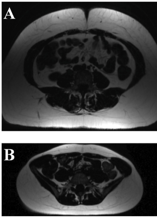 Visceral Fat Mass Images From A Obese Bmi 37 3 Kg M2 Open I