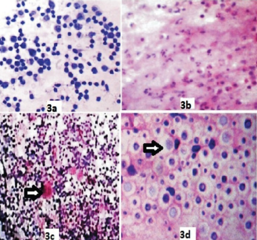 Various non neoplastic cytological patterns of HIV lymp | Open-i