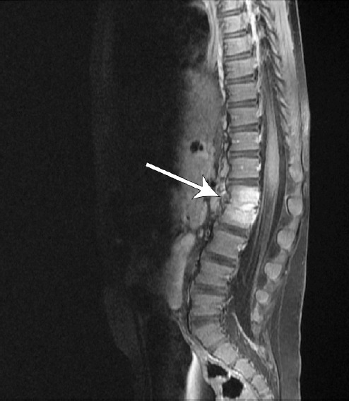 MRI spine with GAD showed a discitis at L1-2 without si | Open-i