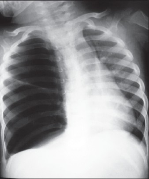 What are bronchovascular markings? - paperwingrvice.web.fc2.com