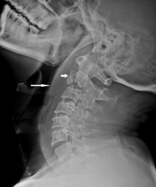 Lateral radiograph of the cervical spine shows a fractu | Open-i