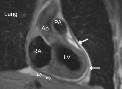 Coronal MRI through the left ventricular outflow tract | Open-i
