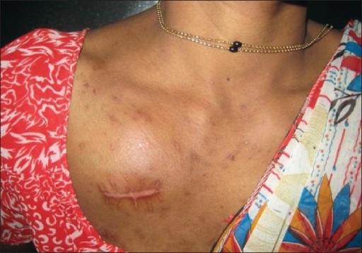swollen supraclavicular and infraclavicular lymph nodes