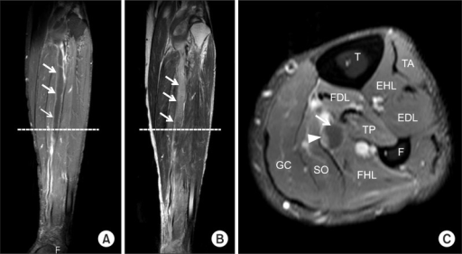 (A) T1-weighted contrast enhanced coronal and (B) T2-we | Open-i