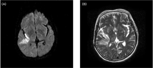 Diffusion-weighted Magnetic Resonance Imaging (MRI) (A) | Open-i