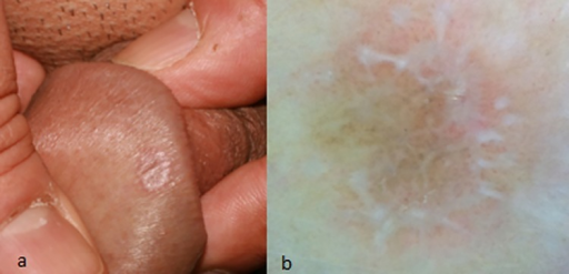 Skin Lesions On Penis 34