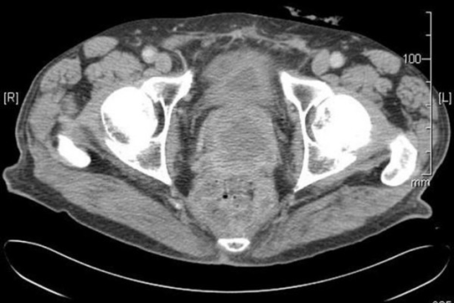 Ct Scan Of The Pelvis Showing Prostatic Mass Open I 3919