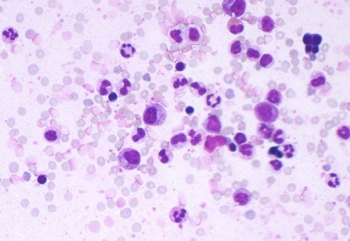 Typical example of a smear of a bone marrow aspirate. I | Open-i