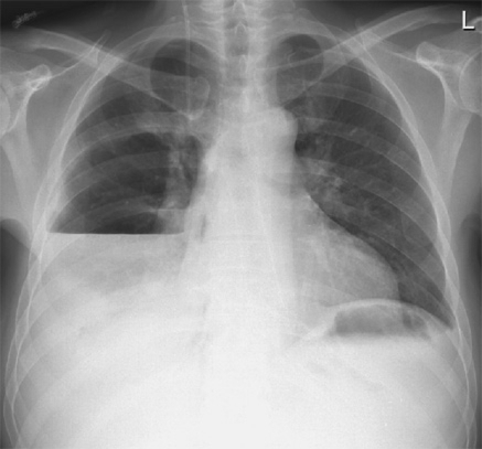 Chest X-ray showing development of a right-sided empyem | Open-i