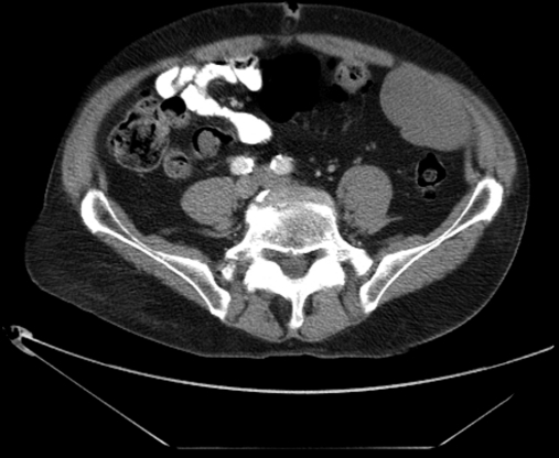 CT abdomen/pelvis showing well-circumscribed mass arisi | Open-i