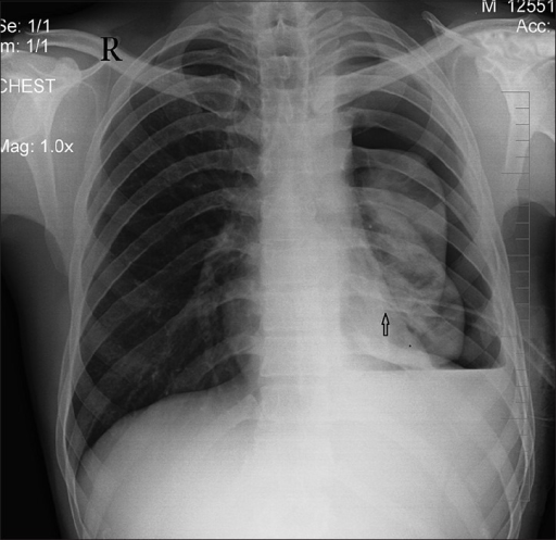 Chest X-ray showing malpositioned intercostal drainage | Open-i