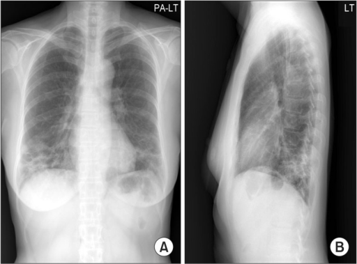 Chest posterior-anterior (A) and left lateral (B) X-ray ...