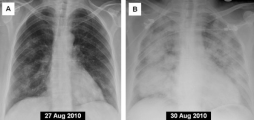 Posterior-anterior chest X-ray 4 days prior to admissio | Open-i